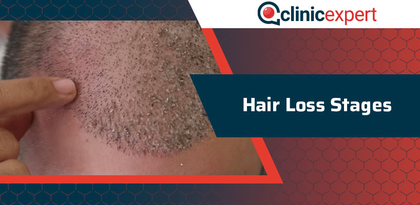 Hair Loss Stages