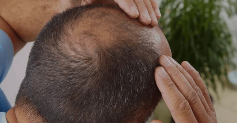 How Long Does A Hair Transplant Take?