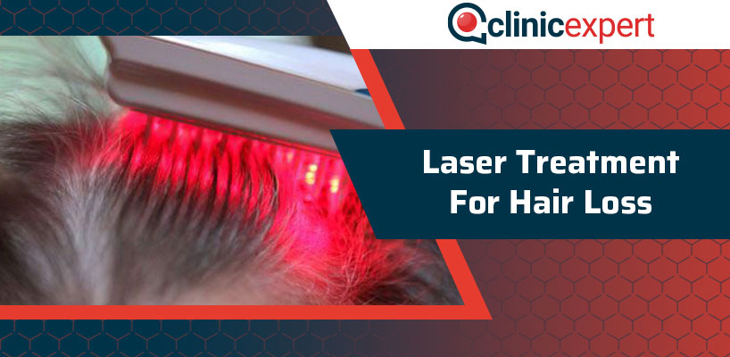 Laser Treatment For Hair Loss