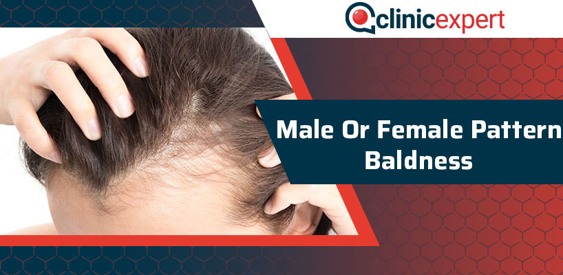 Male Or Female Pattern Baldness