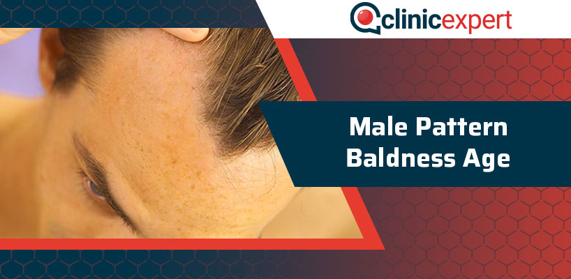 Male Pattern Baldness Age