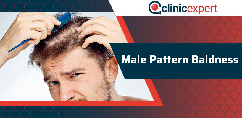 Male Pattern Baldness