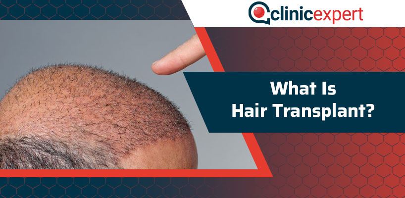 What Is Hair Transplant Surgery? | ClinicExpert