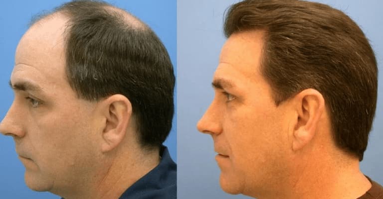 What Is Hair Transplant?