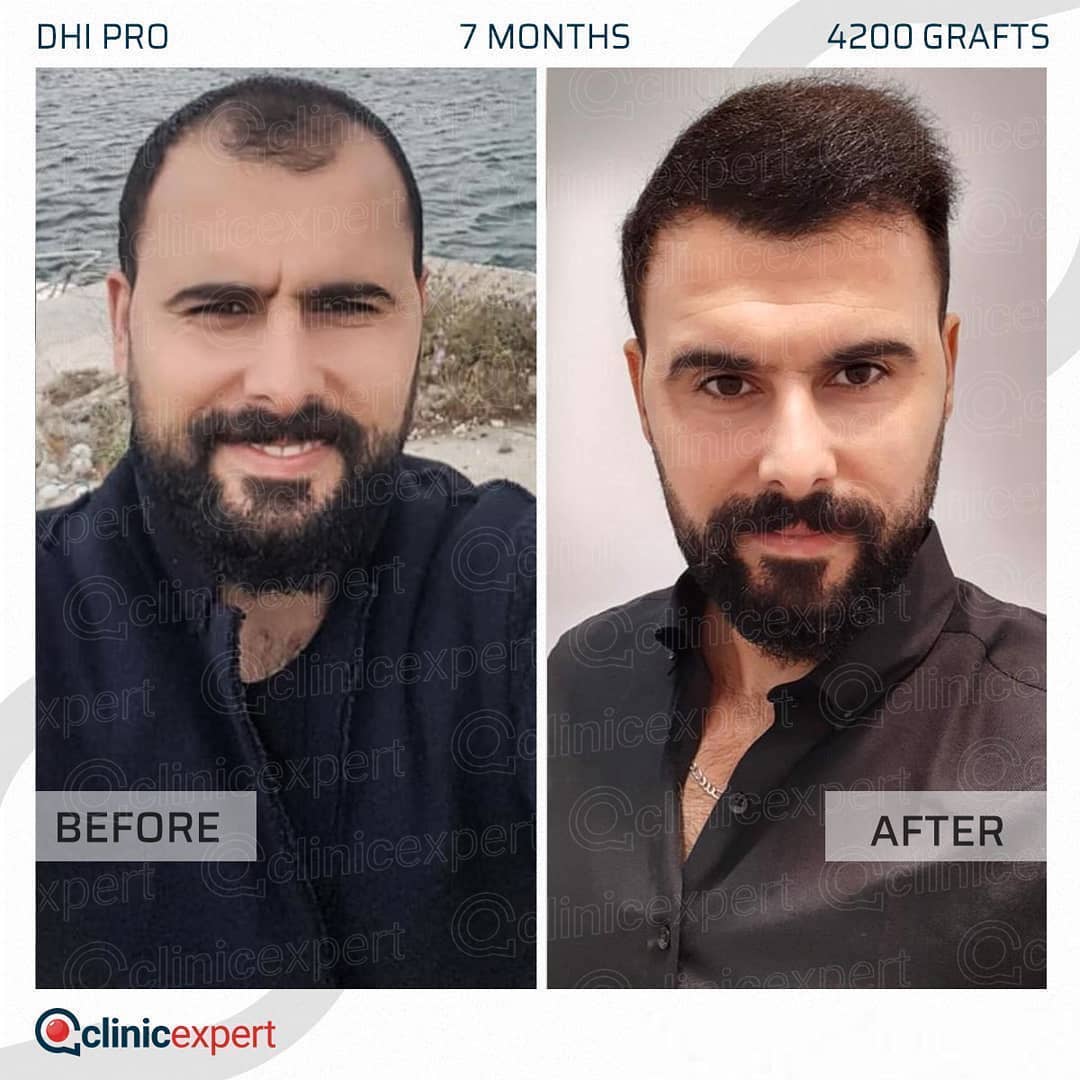 DHI Pro Hair Transplant | ClinicExpert DHI Pro Hair Transplant | ClinicExpert