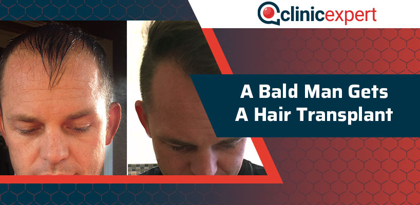 A Bald Man Gets a Hair Transplant