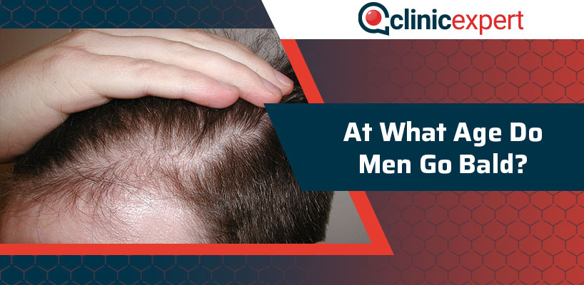 At What Age Do Men Go Bald?