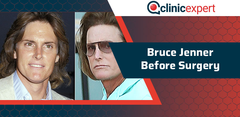 Bruce Jenner Before Surgery
