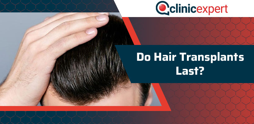 Do Hair Transplants Last?