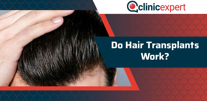 Do Hair Transplants Work?