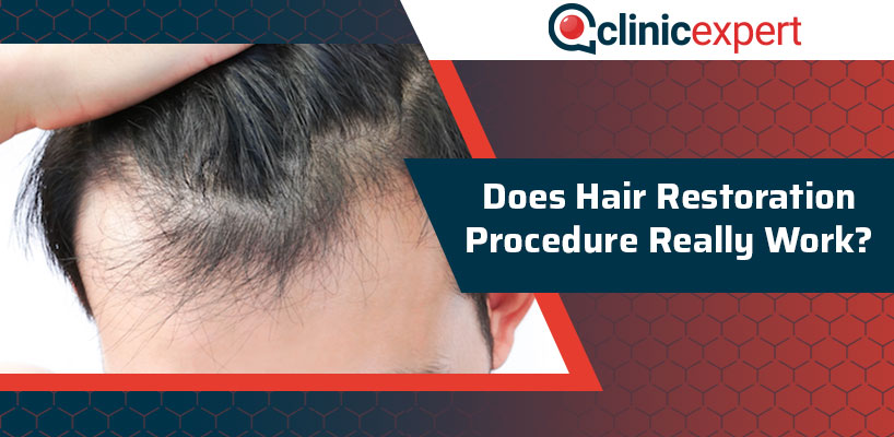 Does Hair Restoration Procedure Really Work? | ClinicExpert