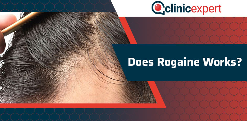 Does Rogaine Works?