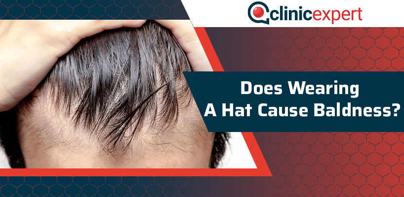 Does Wearing a Hat Cause Baldness?