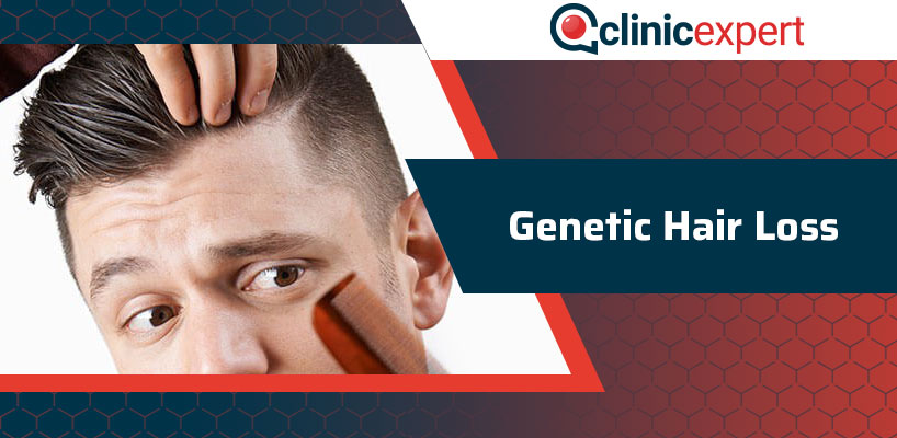 Genetic Hair Loss