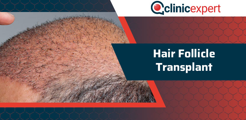 Hair Follicle Transplant