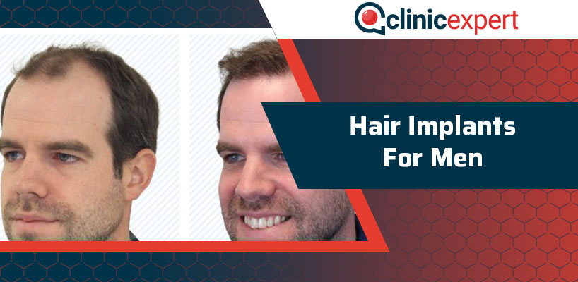 Hair Implants for Men