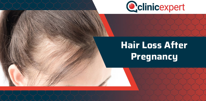 Hair Loss After Pregnancy | ClinicExpert