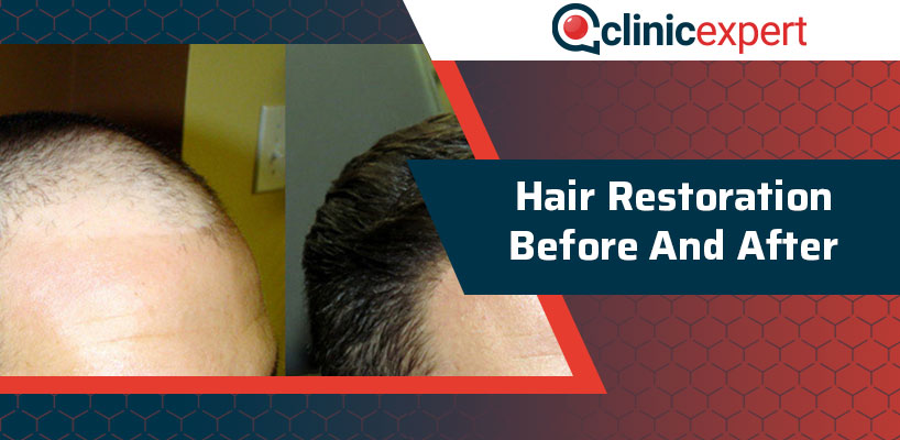 Hair Restoration Before and After