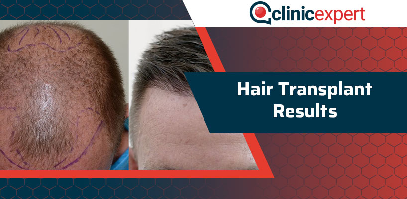 Hair Transplant Results | ClinicExpert International Healthcare