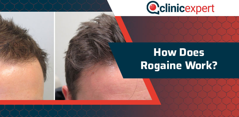 How Does Rogaine Work? | ClinicExpert
