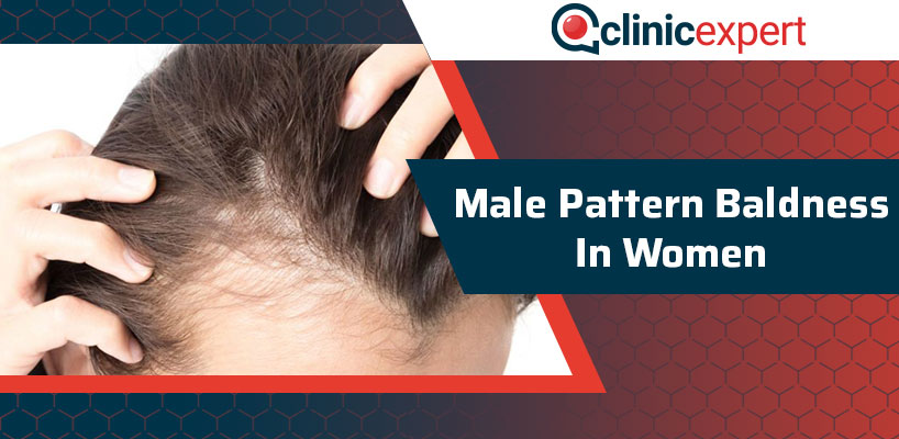 Male Pattern Baldness in Women