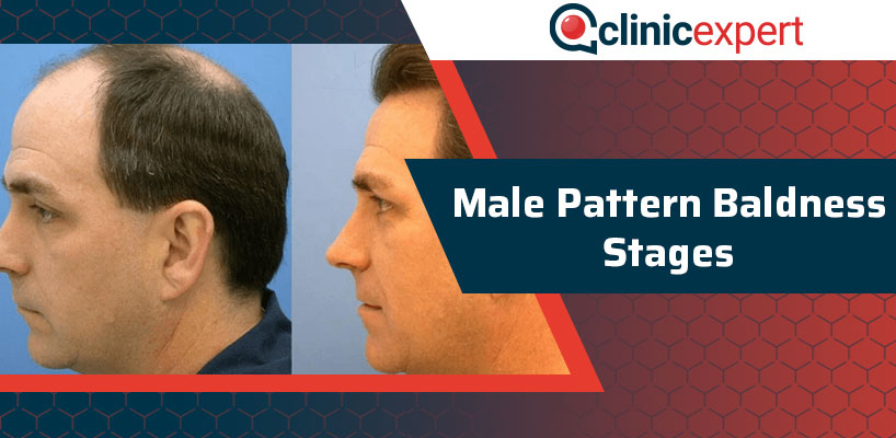 Male Pattern Baldness Stages | ClinicExpert Healthcare