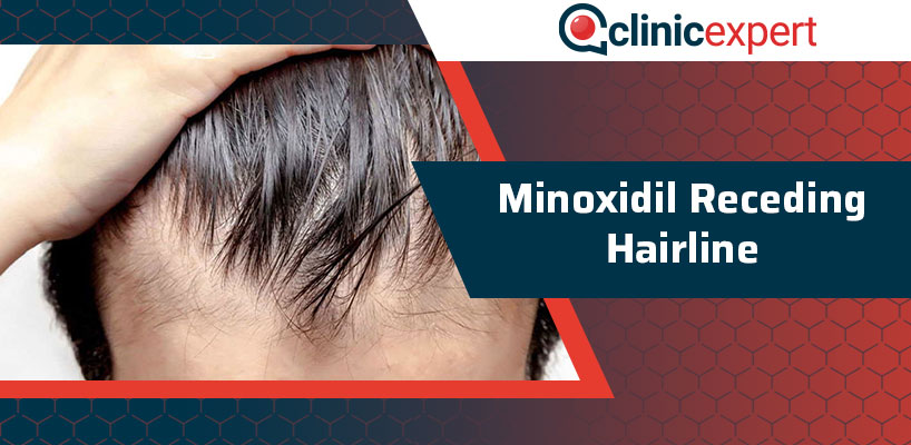 Minoxidil Receding Hairline | ClinicExpert