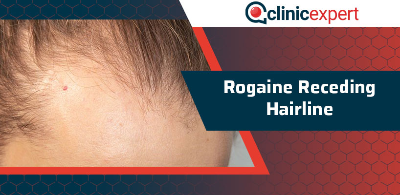 Rogaine Receding Hairline