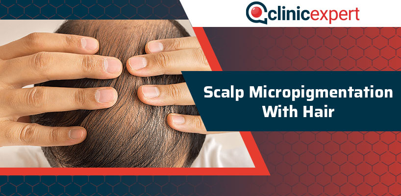 Scalp Micropigmentation With Hair