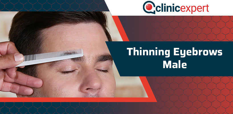 Thinning Eyebrows Male