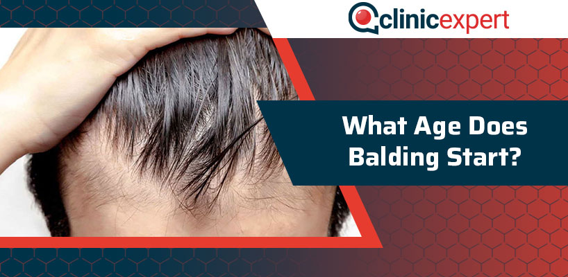 What Age Does Balding Start Clinicexpert Healthcare