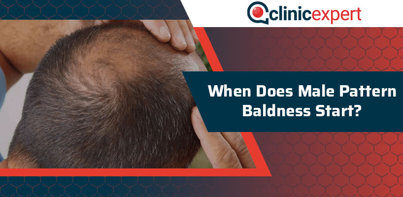 When Does Male Pattern Baldness Start?
