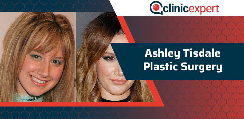 Ashley Tisdale Plastic Surgery