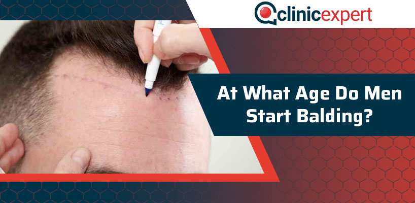 At What Age Do Men Start Balding? | ClinicExpert International ...