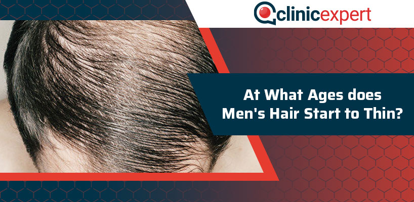 At What Ages does Men's Hair Start to Thin?