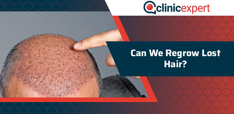 Can We Regrow Lost Hair?