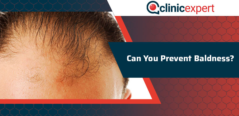 Can You Prevent Baldness From Occurring?