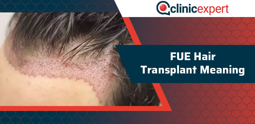 Fue Hair Transplant Meaning