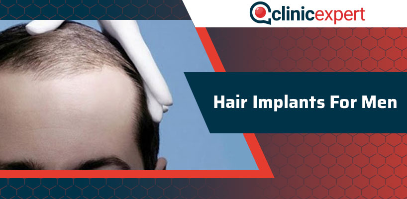 Hair Implants For Men