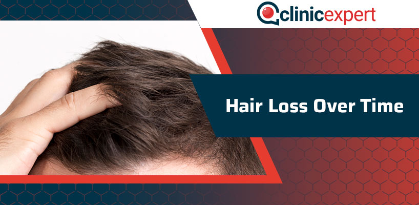 Hair Loss Over Time