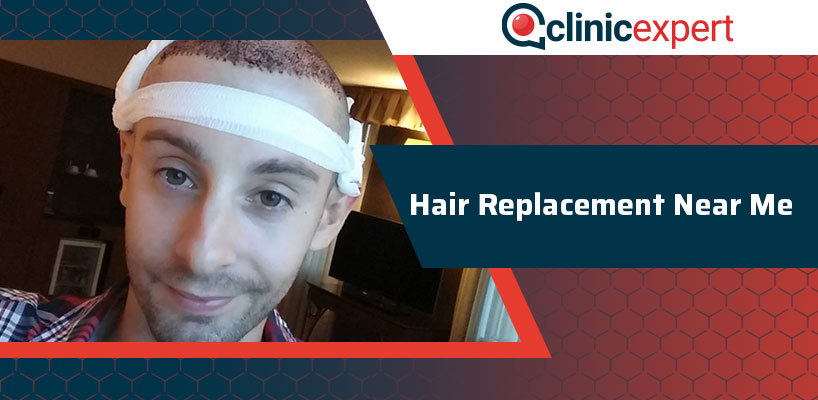 Hair Replacement Near Me