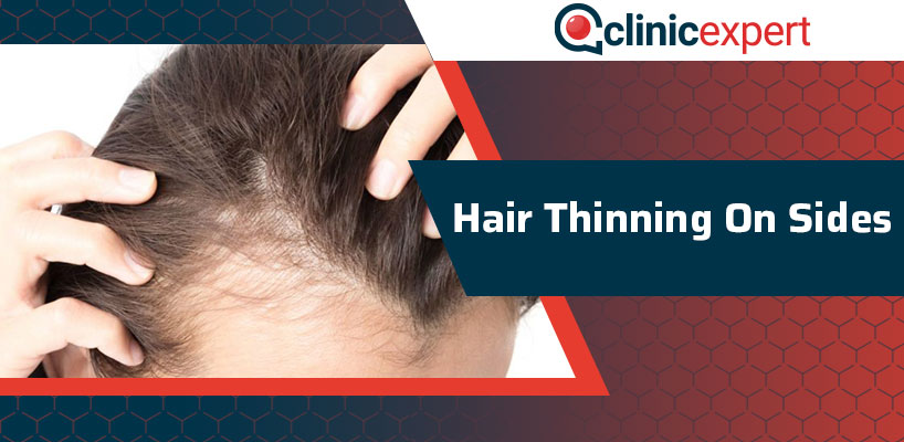 Hair Thinning on Sides