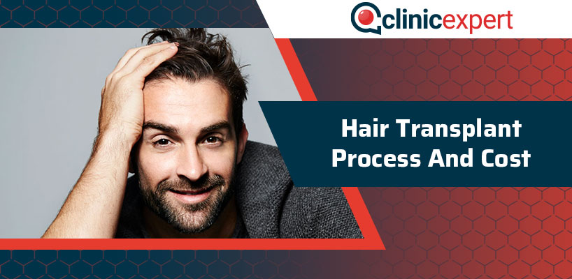 Hair Transplant Process And Cost