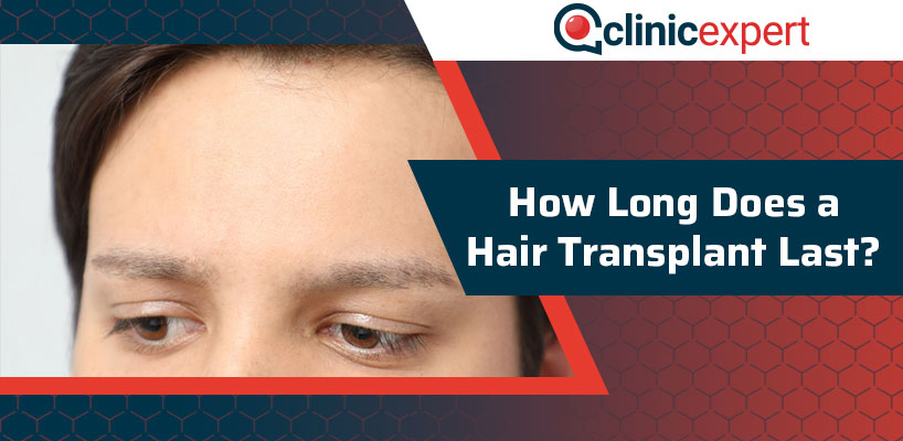 How Long Does a Hair Transplant Last? | ClinicExpert