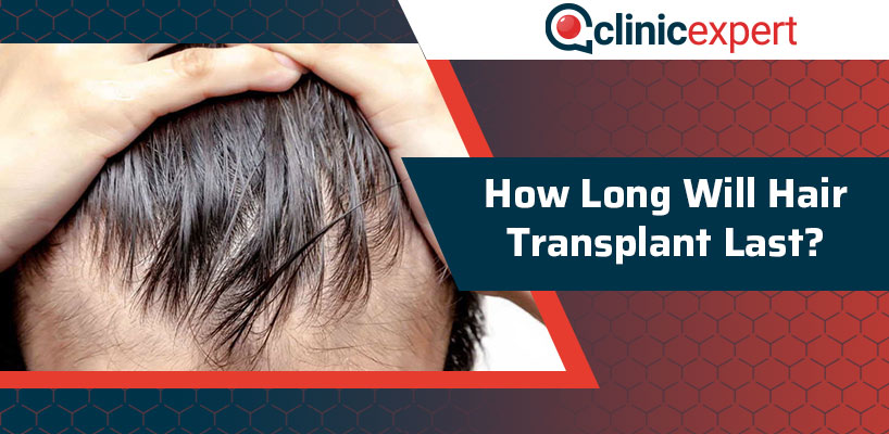 How Long Will Hair Transplant Last? | ClinicExpert International Healthcare