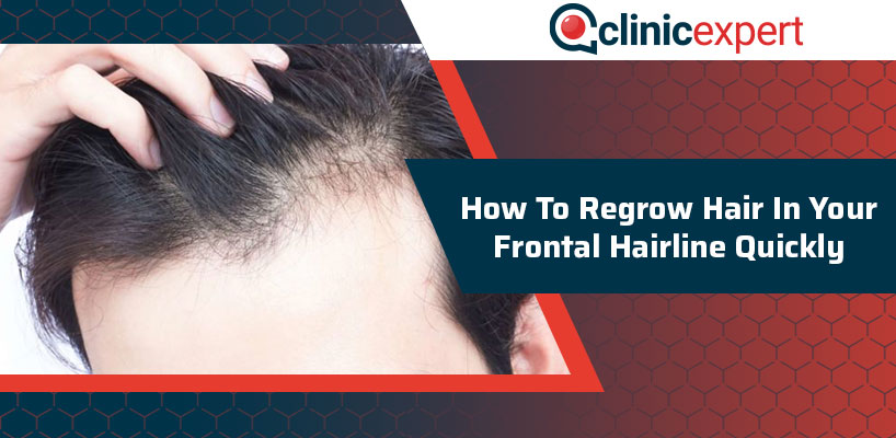 How To Regrow Hair In Your Frontal Hairline Quickly?