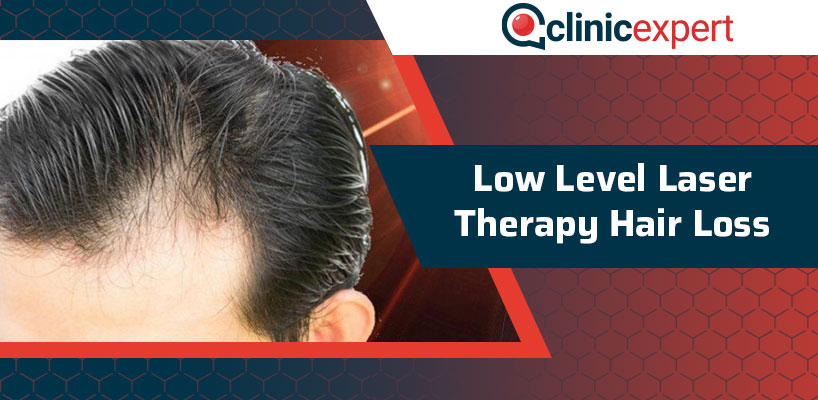 Low Level Laser Therapy Hair Loss