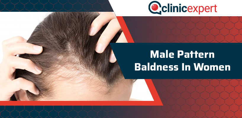 Male Pattern Baldness In Women