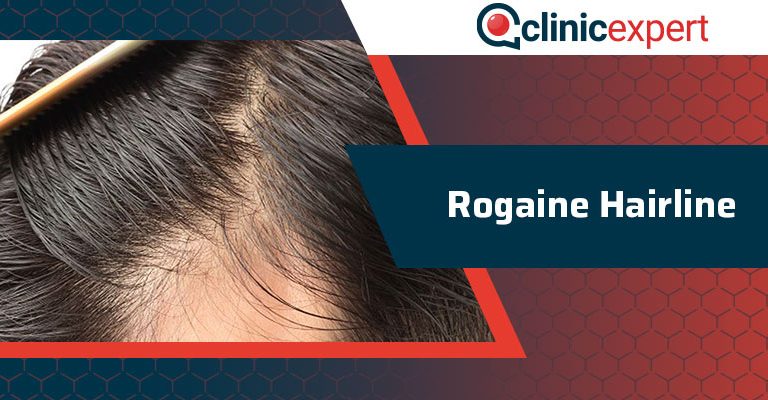 Rogaine Hairline