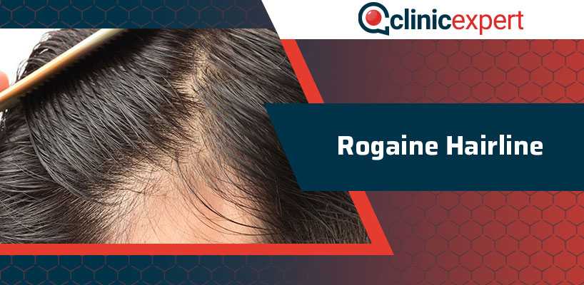 Rogaine Hairline